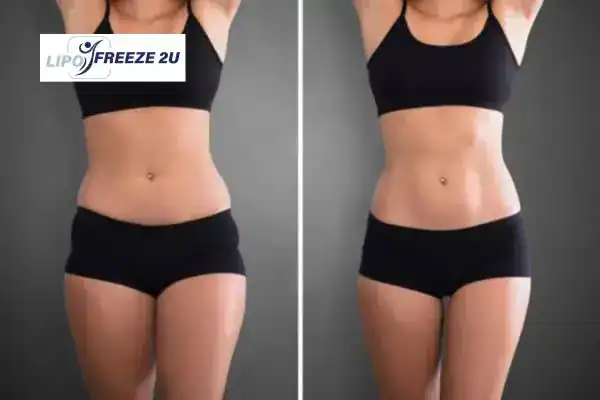 How Can LIPO FREEZE 2U Support Your Post-Pregnancy Body Recovery St Albans?