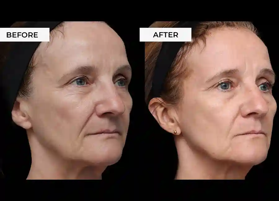 How Many RF Microneedling Sessions Will You Need to See a Difference St Albans?