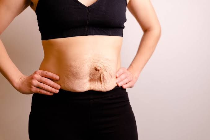 Is Surgery Really the Only Way to Repair Diastasis Recti St Albans?