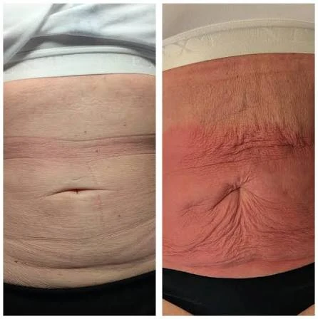 How Does RF Microneedling Improve Crepey, Thin and Uneven Skin Texture St Albans?