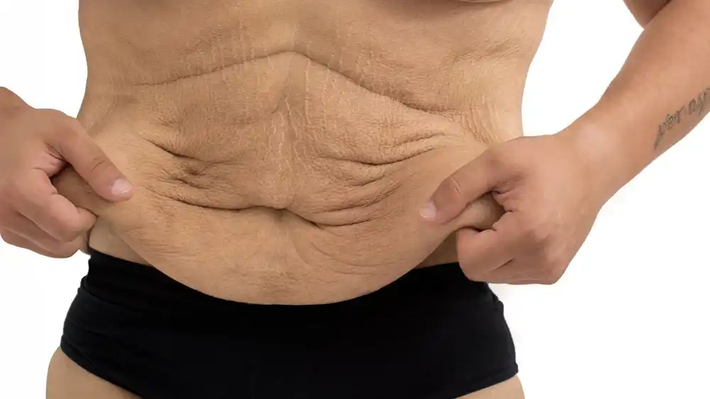 Why Does Weight Loss Medication Leave Some People With Loose or Sagging Skin St Albans?
